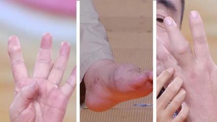 手脚容易发麻是怎么回事