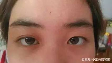 割了双眼皮多久可以碰水