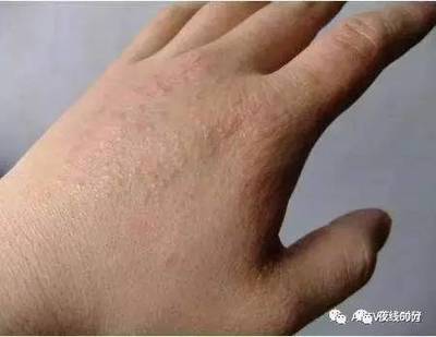 手破皮是怎么回事