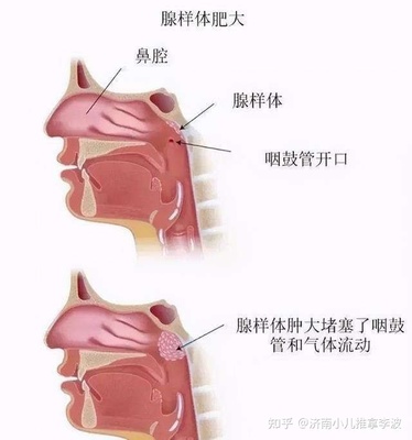 咽鼓管堵塞怎么治疗