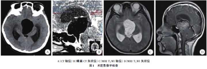 经鼻蝶微创垂体囊肿手术费用多少钱