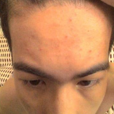 额头下边长痘痘怎么回事