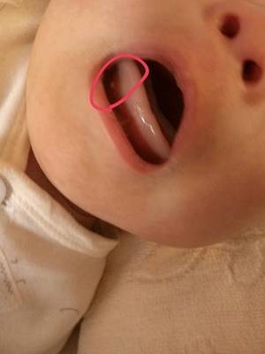一个月婴儿拉肚子怎么办
