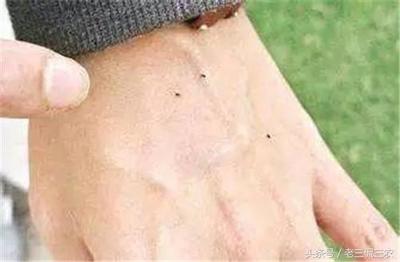 拍手掌可以治痘痘吗