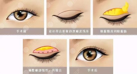眼皮为什么一单一双
