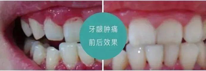 牙龈肿痛是怎么回事