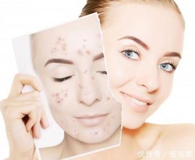 吃什么可以去痘印