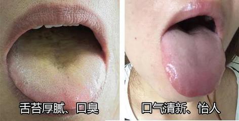舌苔没了是怎么回事