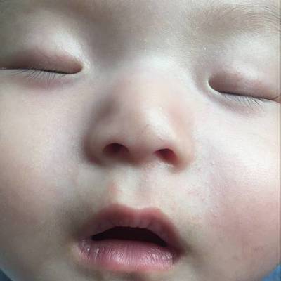 鼻子上的痘痘四个月了