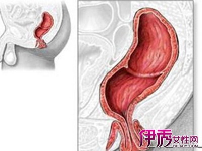 肠套叠是怎么回事