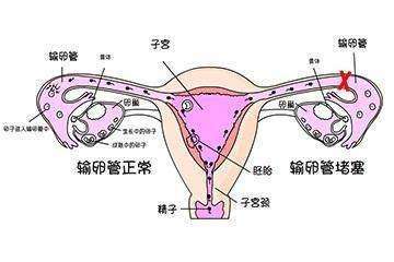 输卵管不通是怎么回事