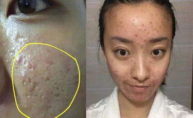 痘印和痘疤