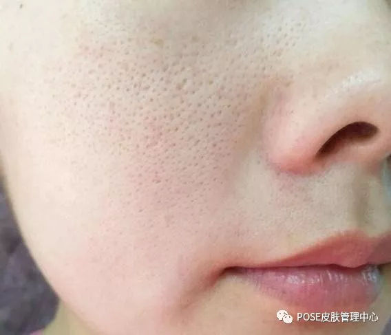 脸上毛孔大怎么办