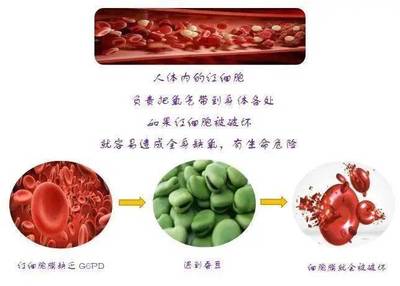 蚕豆病溶血怎么治疗