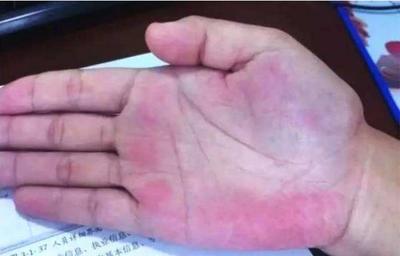 大小鱼际发红是怎么回事