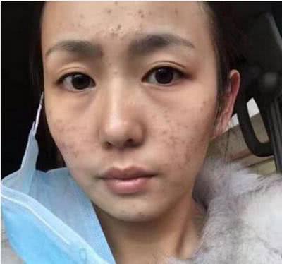开塞露真的能祛斑吗