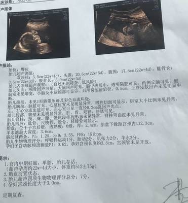 染色体平衡易位孕9个月