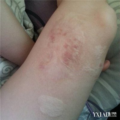如何去除烫伤的疤痕