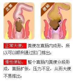 怎么治疗肛裂