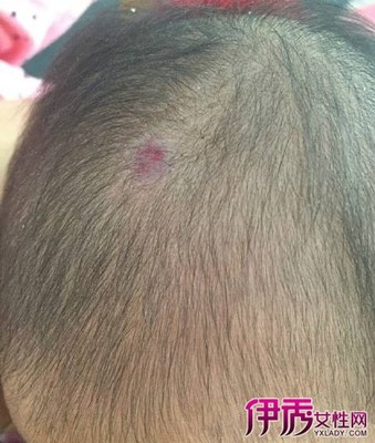 头皮里长疙瘩是怎么回事