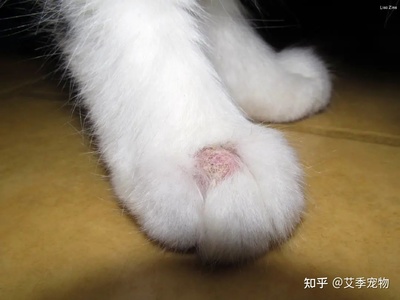 人长猫癣怎么治疗