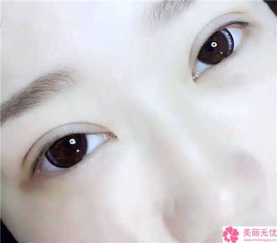 割完双眼皮后吃什么