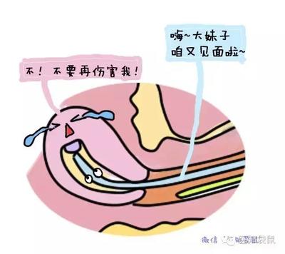怀孕药流过程