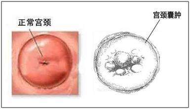 宫颈囊肿是怎么回事