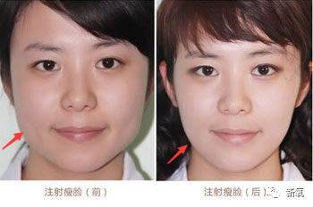 笑能瘦脸吗