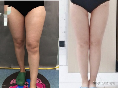 大腿抽脂三天后的照片