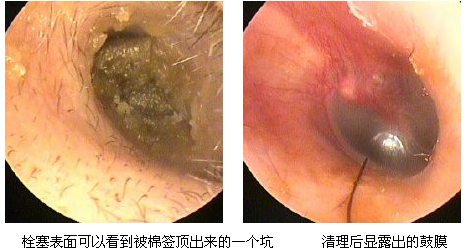 宝宝正常耳屎图片