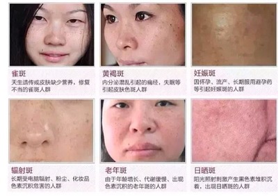怀孕后长斑是什么原因