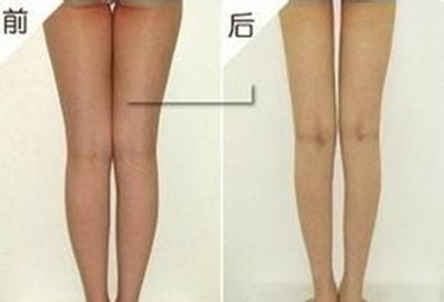 瘦腿吸脂