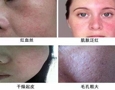 用洗面奶脸上干燥起皮
