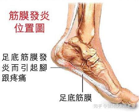 足底筋膜炎怎么治疗