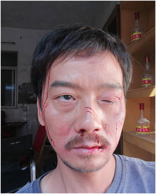 额头右边疼是怎么回事