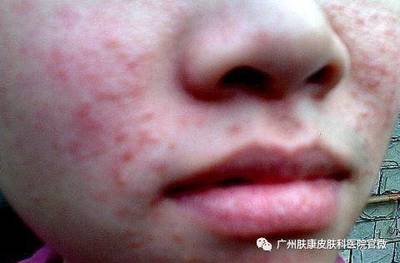 青春期结束后还长痘痘