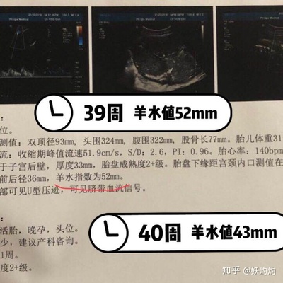 足月胎儿股骨长标准