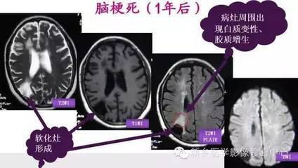脑梗是怎么回事