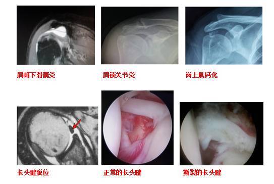 脾钙化要怎么治疗