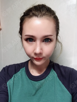 开眼角拆线后多久化妆