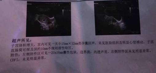 什么检查能查出怀孕