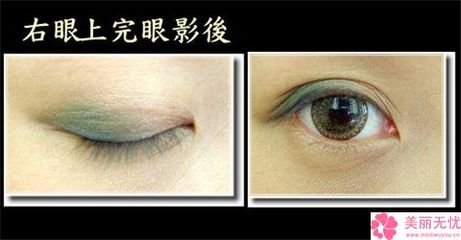 高分子埋线双眼皮多少钱