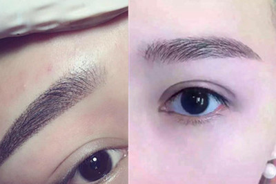 整容双眼皮的危害