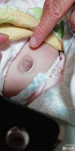 新生儿肚脐眼图片
