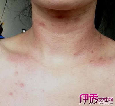 孕妇脖子上长痘痘怎么办