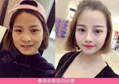 隆鼻等老了以后后遗症