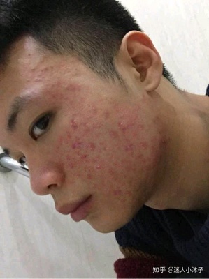 满脸痘印