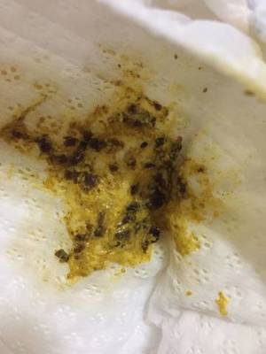 宝宝拉屎有黑色颗粒