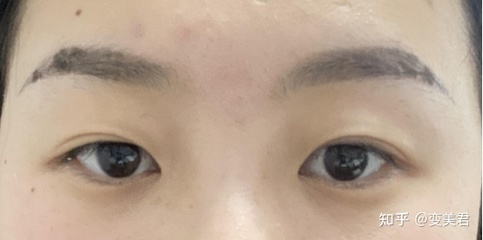 纹眉后里面有痘痘